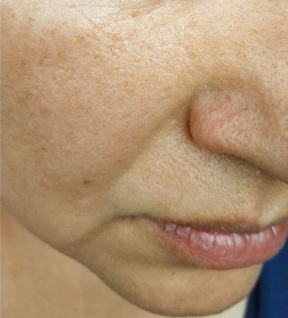 At the age of 40, nasolabial folds appear