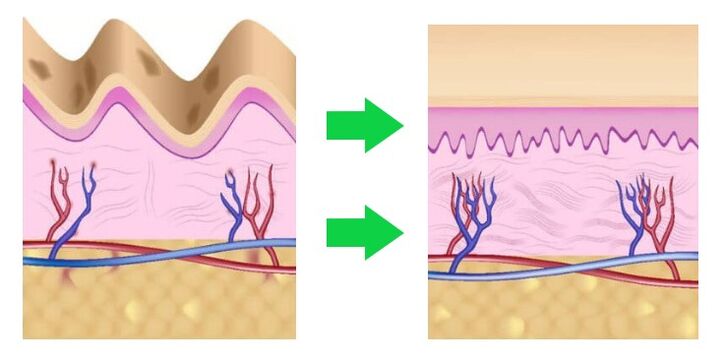 Intenskin flattens the skin